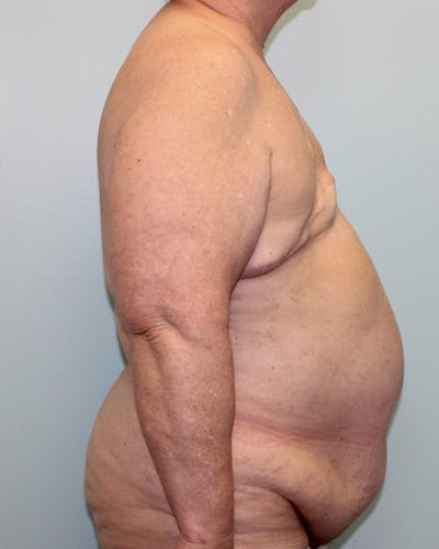 Breast Reconstruction Gallery - Patient 5799711 - Image 1