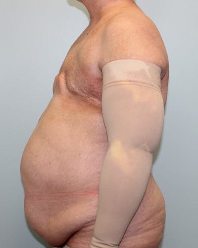 Breast Reconstruction Gallery - Patient 5799711 - Image 2