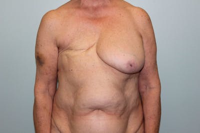 Breast Reconstruction Before & After Gallery - Patient 5799715 - Image 1