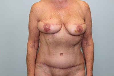 Breast Reconstruction Before & After Gallery - Patient 5799715 - Image 2