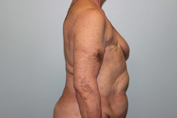 Breast Reconstruction Before & After Gallery - Patient 5799715 - Image 5
