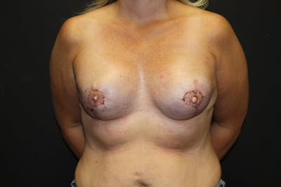 Breast Reconstruction Before & After Gallery - Patient 5799723 - Image 2