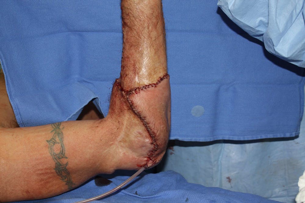 Extremity Reconstruction Before & After Gallery - Patient 5799790 - Image 3