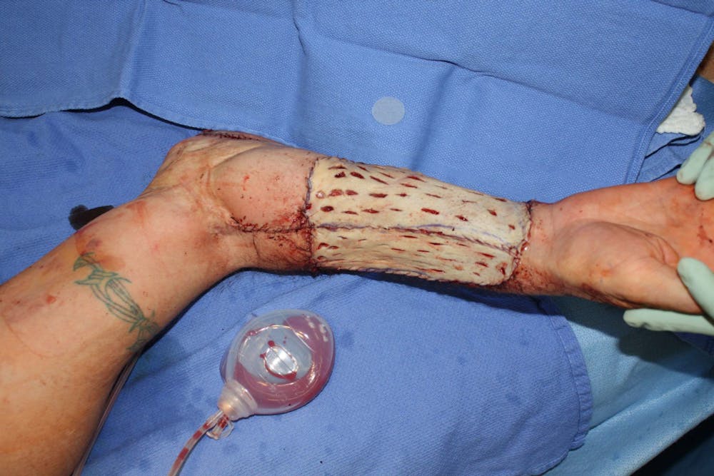 Extremity Reconstruction Before & After Gallery - Patient 5799790 - Image 4