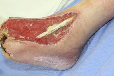 Extremity Reconstruction Before & After Gallery - Patient 5799794 - Image 1