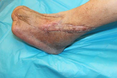 Extremity Reconstruction Before & After Gallery - Patient 5799794 - Image 2