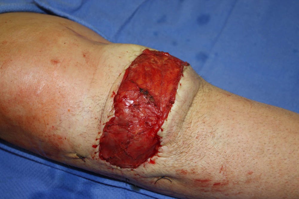 Extremity Reconstruction Before & After Gallery - Patient 5799798 - Image 3