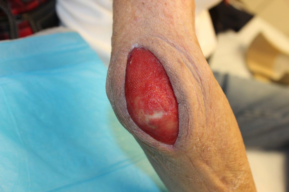Extremity Reconstruction Before & After Gallery - Patient 5799804 - Image 1