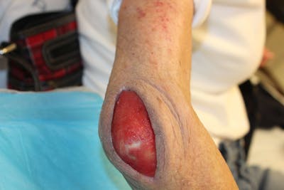 Extremity Reconstruction Before & After Gallery - Patient 5799804 - Image 2
