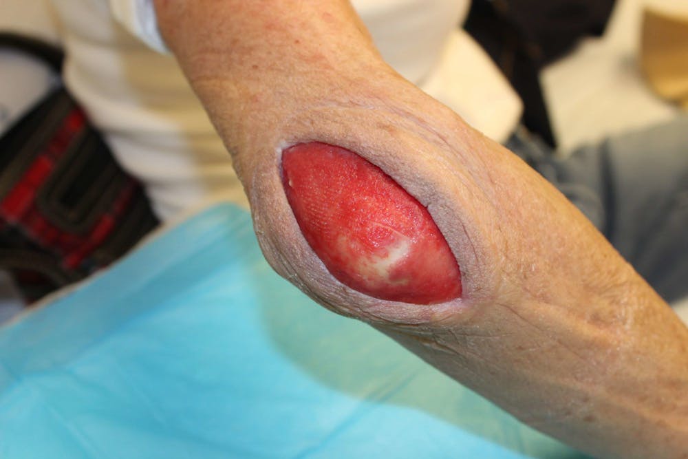 Extremity Reconstruction Before & After Gallery - Patient 5799804 - Image 3
