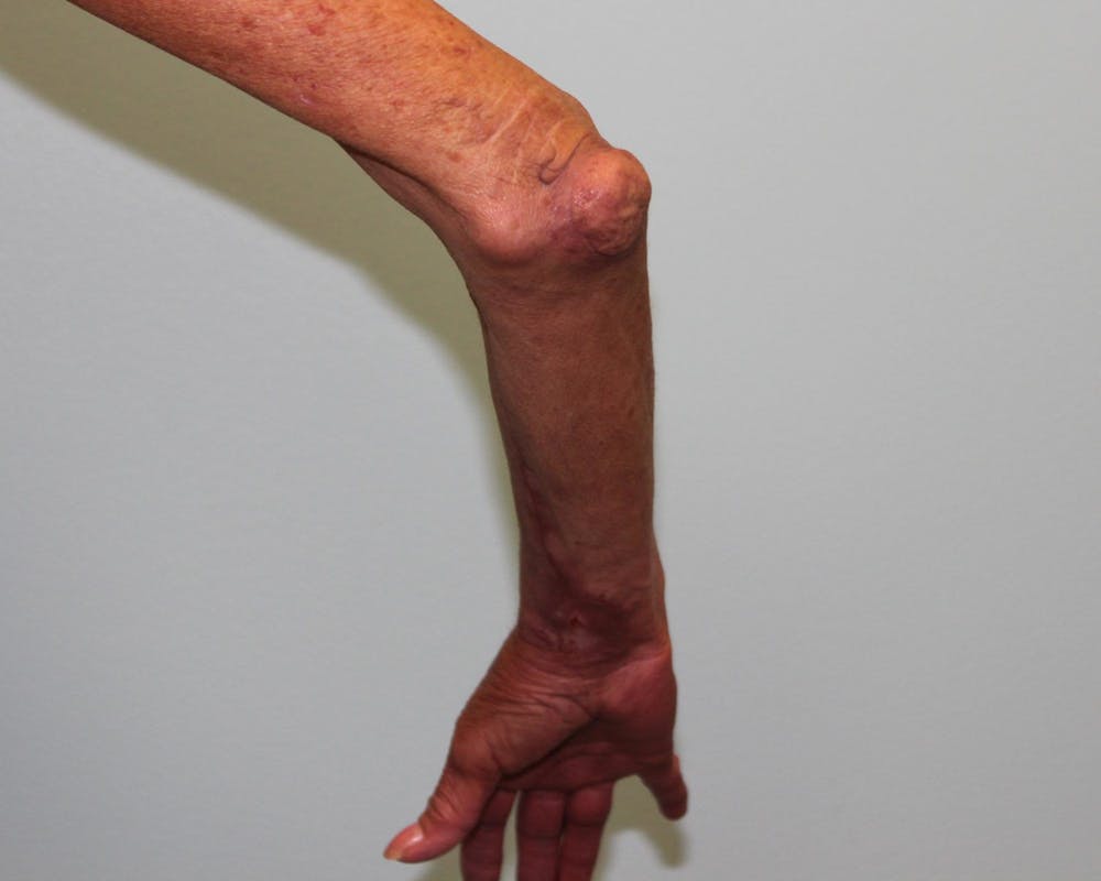 Extremity Reconstruction Before & After Gallery - Patient 5799804 - Image 5