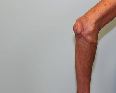 Extremity Reconstruction Before & After Gallery - Patient 5799804 - Image 6