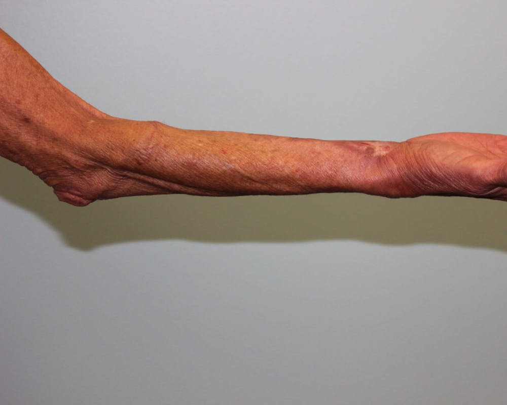 Extremity Reconstruction Before & After Gallery - Patient 5799804 - Image 7