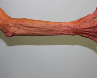 Extremity Reconstruction Before & After Gallery - Patient 5799804 - Image 8