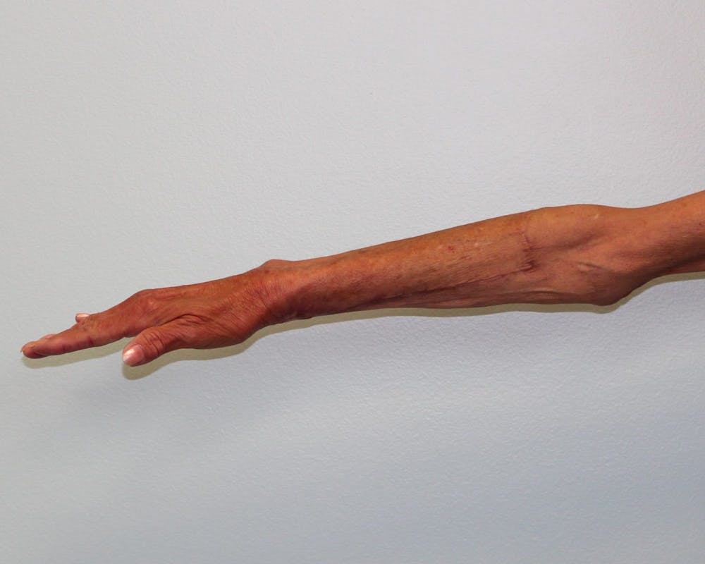 Extremity Reconstruction Before & After Gallery - Patient 5799804 - Image 9