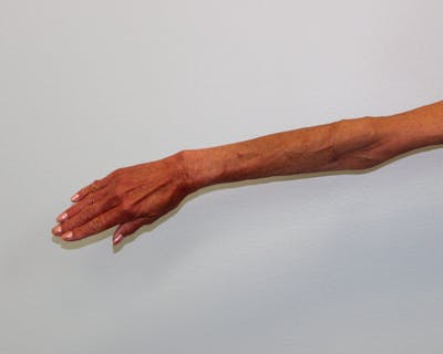 Extremity Reconstruction Before & After Gallery - Patient 5799804 - Image 10