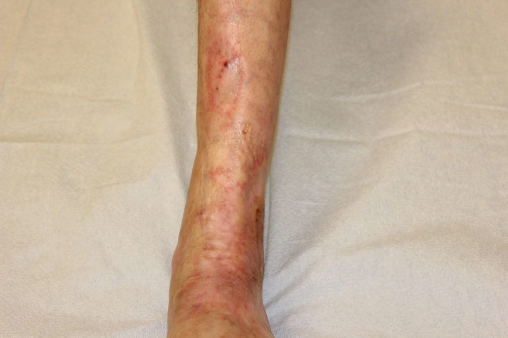 Extremity Reconstruction Before & After Gallery - Patient 5799808 - Image 5