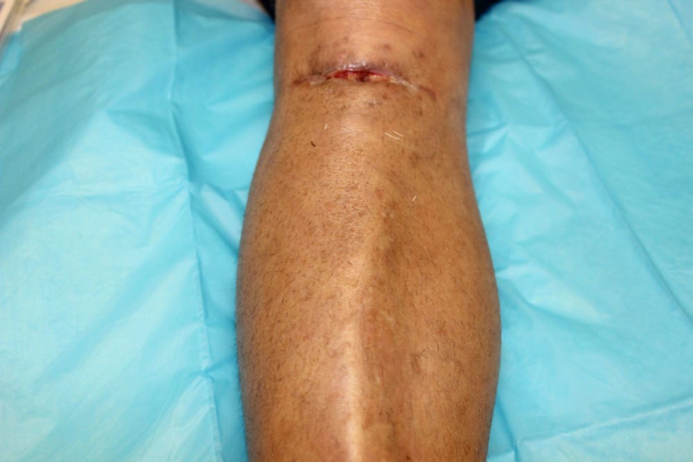 Extremity Reconstruction Before & After Gallery - Patient 5799820 - Image 1