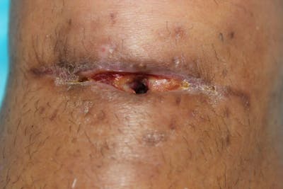 Extremity Reconstruction Before & After Gallery - Patient 5799820 - Image 2