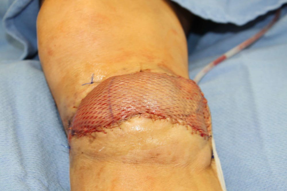 Extremity Reconstruction Before & After Gallery - Patient 5799820 - Image 3