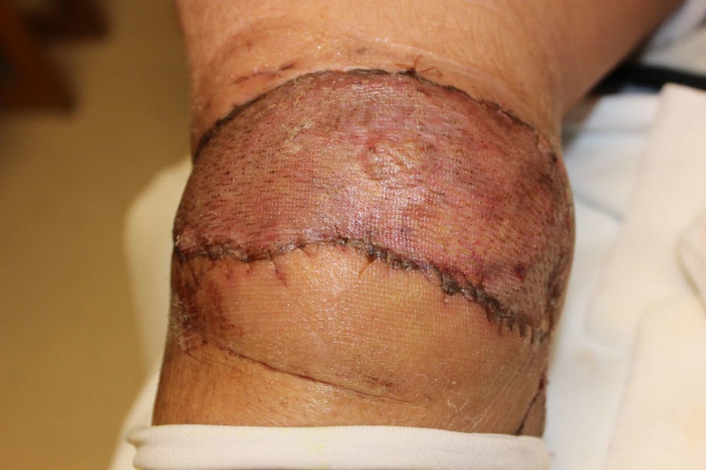 Extremity Reconstruction Before & After Gallery - Patient 5799820 - Image 4
