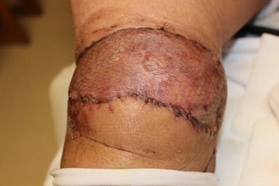 Extremity Reconstruction Before & After Gallery - Patient 5799820 - Image 4