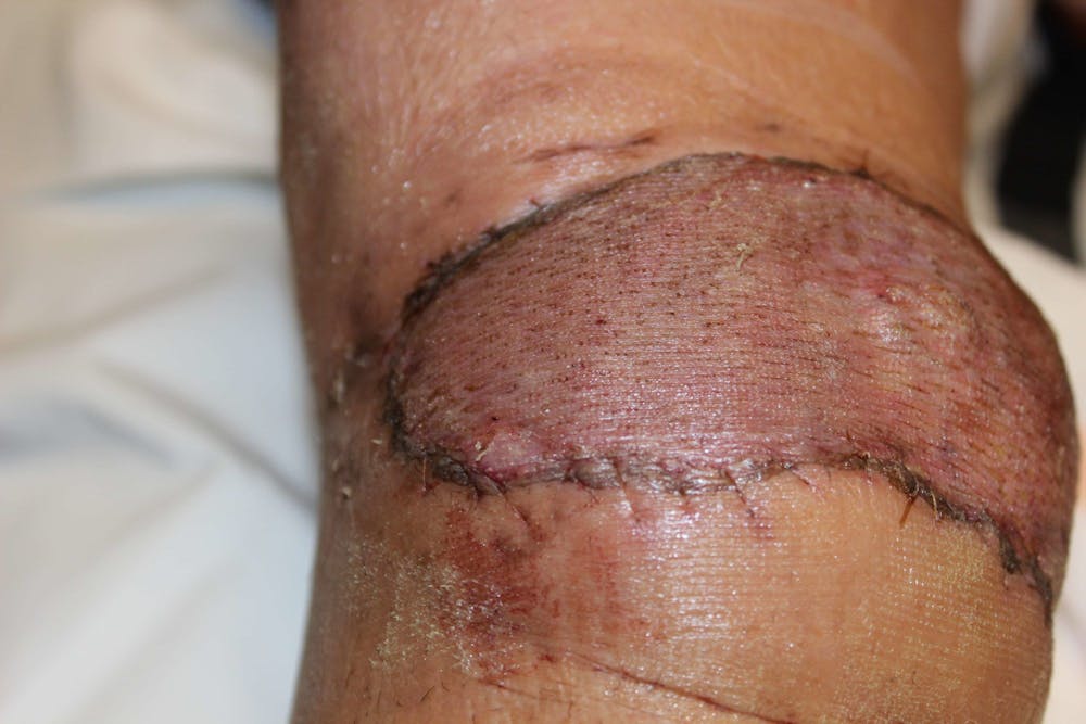 Extremity Reconstruction Before & After Gallery - Patient 5799820 - Image 5