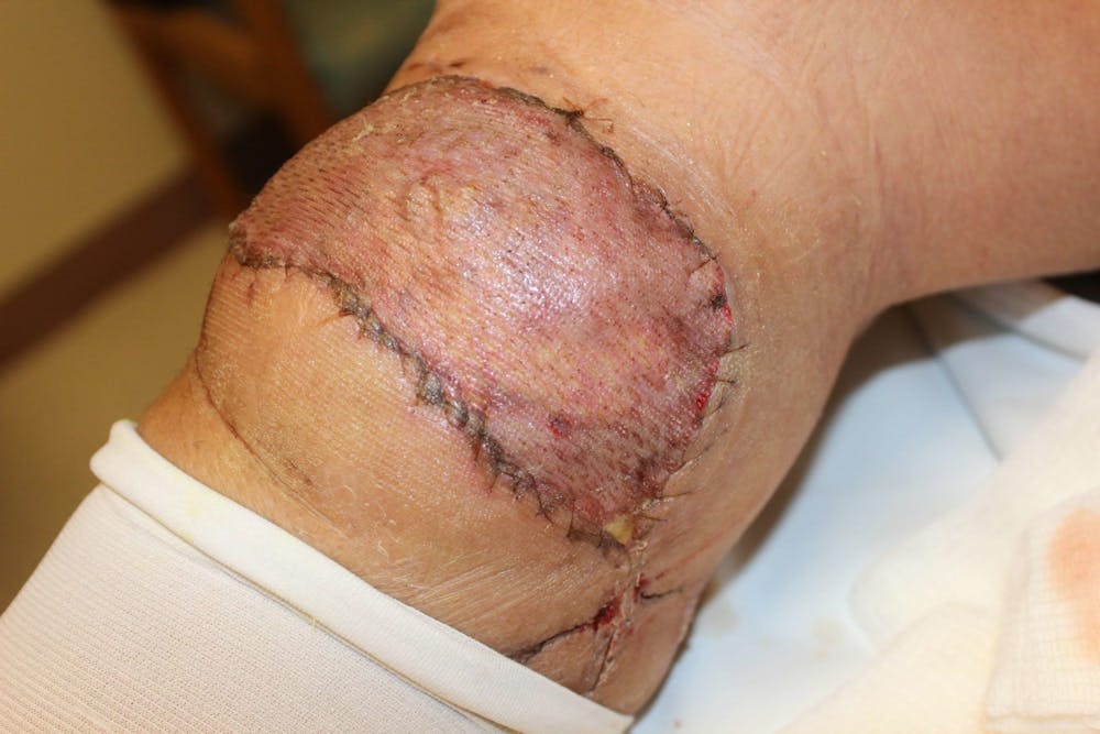 Extremity Reconstruction Before & After Gallery - Patient 5799820 - Image 6