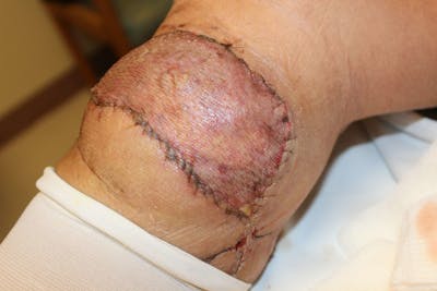 Extremity Reconstruction Before & After Gallery - Patient 5799820 - Image 6