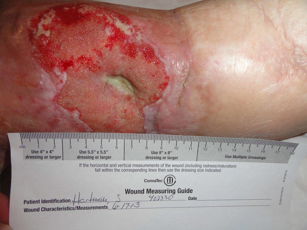 Extremity Reconstruction Before & After Gallery - Patient 5799821 - Image 2