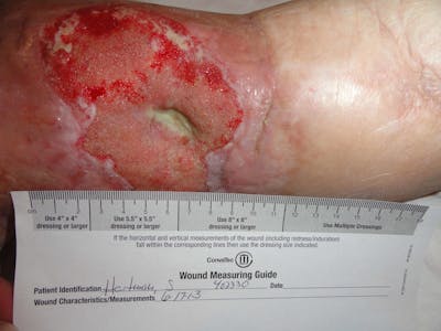 Extremity Reconstruction Before & After Gallery - Patient 5799821 - Image 2