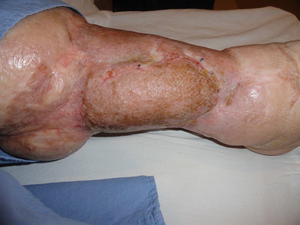 Extremity Reconstruction Before & After Gallery - Patient 5799821 - Image 3
