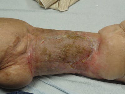 Extremity Reconstruction Before & After Gallery - Patient 5799821 - Image 4
