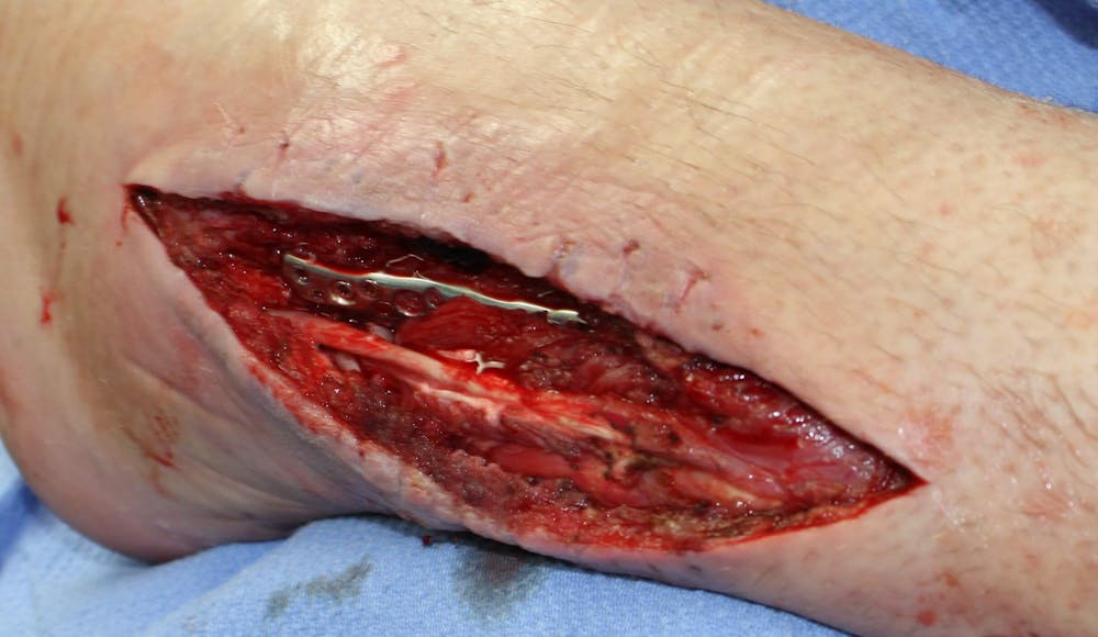 Extremity Reconstruction Before & After Gallery - Patient 5799831 - Image 1