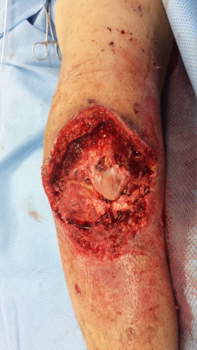 Extremity Reconstruction Before & After Gallery - Patient 5799836 - Image 1