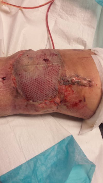 Extremity Reconstruction Before & After Gallery - Patient 5799836 - Image 2