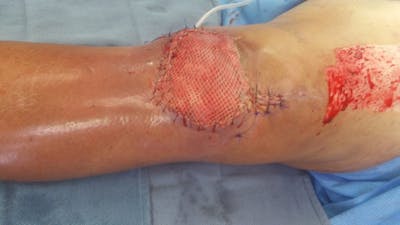 Extremity Reconstruction Before & After Gallery - Patient 5799838 - Image 2