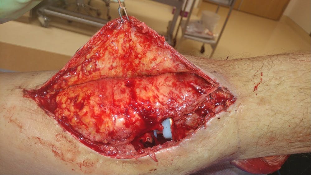 Extremity Reconstruction Before & After Gallery - Patient 5799843 - Image 1