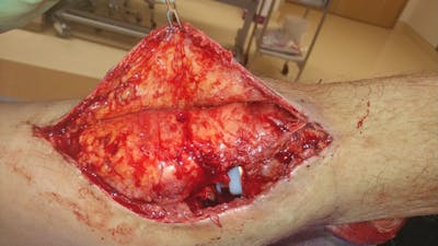 Extremity Reconstruction Before & After Gallery - Patient 5799843 - Image 1