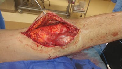 Extremity Reconstruction Before & After Gallery - Patient 5799843 - Image 2