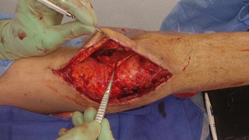 Extremity Reconstruction Before & After Gallery - Patient 5799843 - Image 3