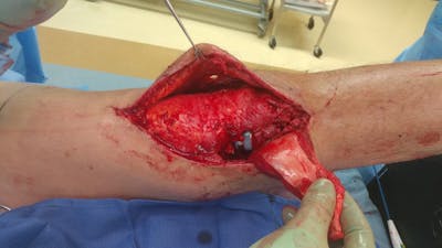 Extremity Reconstruction Before & After Gallery - Patient 5799843 - Image 4