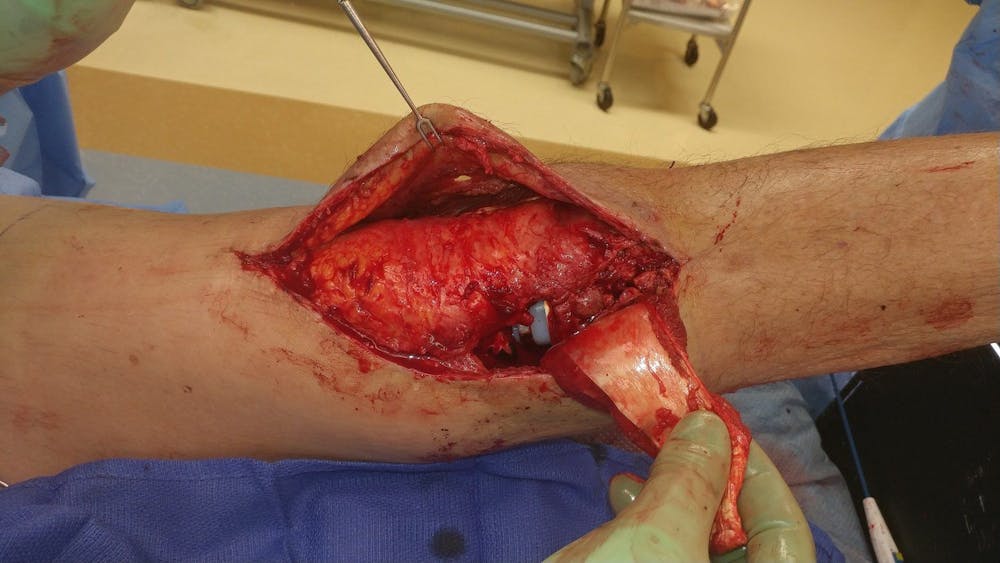 Extremity Reconstruction Before & After Gallery - Patient 5799843 - Image 5