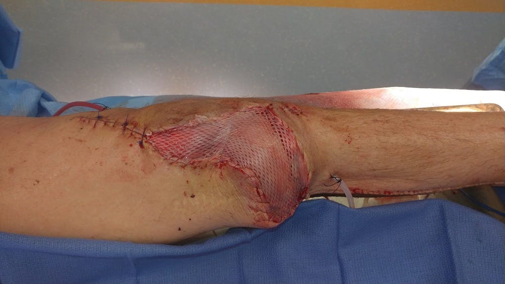 Extremity Reconstruction Before & After Gallery - Patient 5799843 - Image 6
