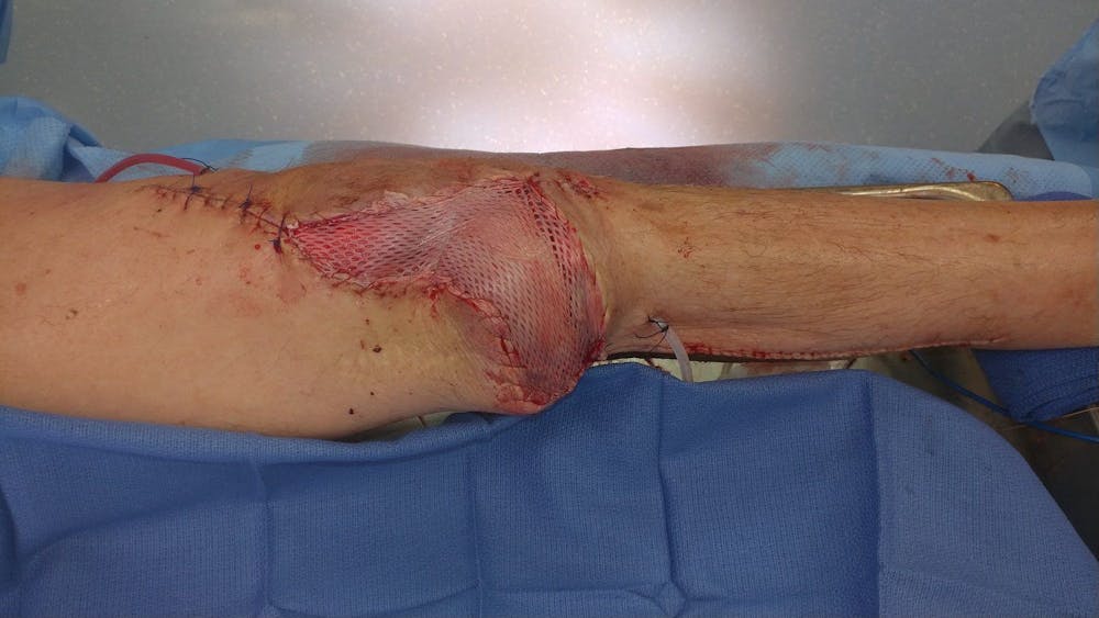 Extremity Reconstruction Before & After Gallery - Patient 5799843 - Image 7