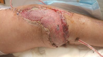 Extremity Reconstruction Before & After Gallery - Patient 5799843 - Image 8