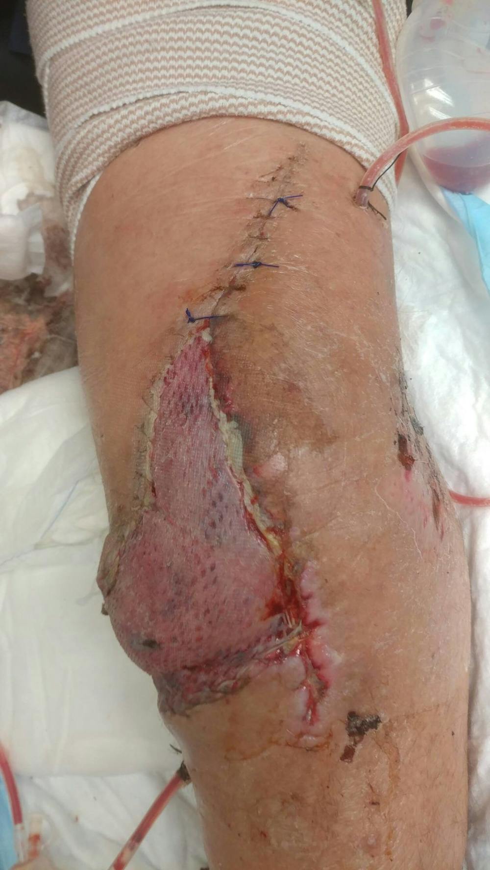 Extremity Reconstruction Before & After Gallery - Patient 5799843 - Image 9