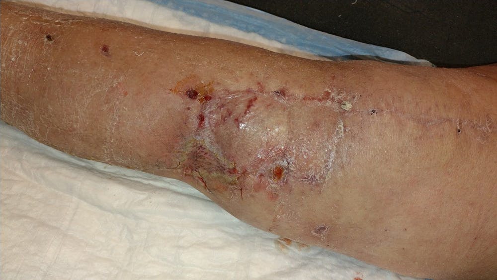 Extremity Reconstruction Before & After Gallery - Patient 5799948 - Image 3