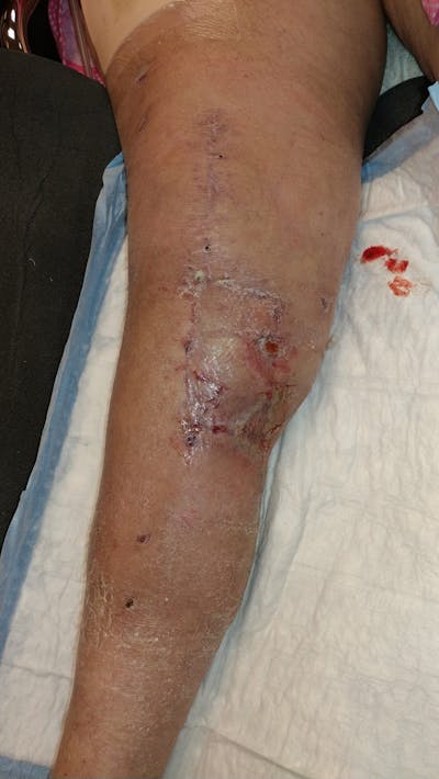 Extremity Reconstruction Before & After Gallery - Patient 5799948 - Image 4