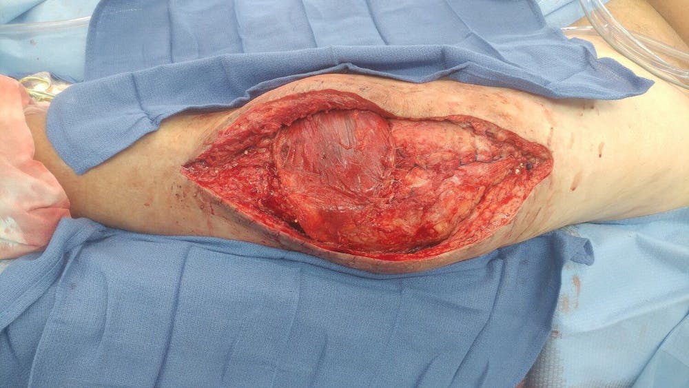 Extremity Reconstruction Before & After Gallery - Patient 5799950 - Image 1
